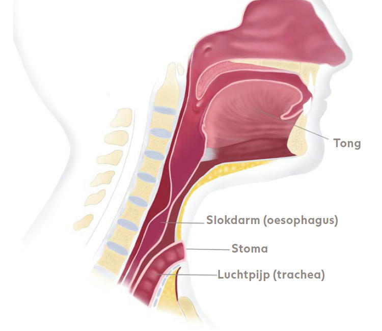 De anatomie na een totale laryngectomie | Atos Medical